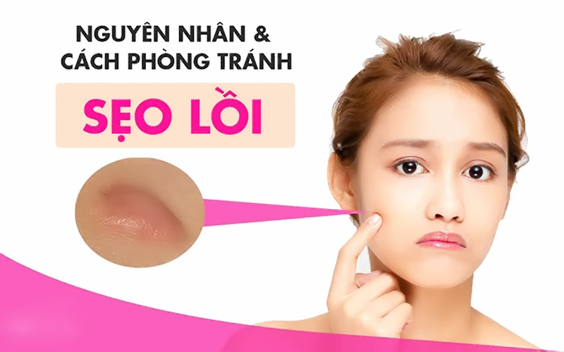 Thuốc trị sẹo lồi - Thành phần và lưu ý chọn mua